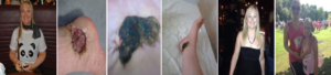 Amandas melanoma