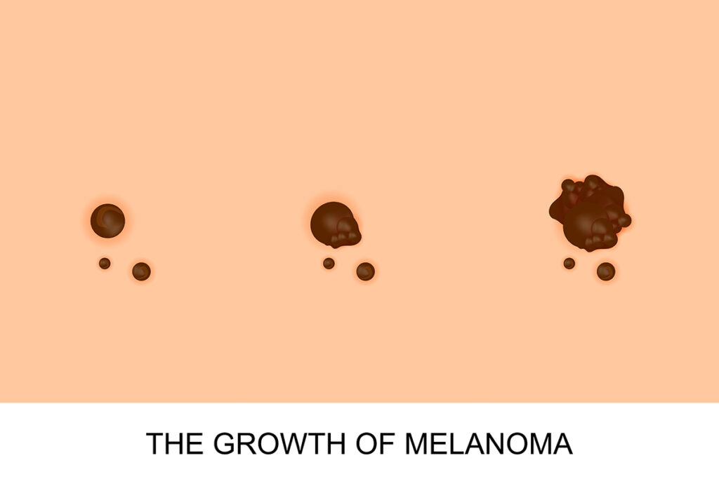Growth Melanoma Illustration Growth Melanoma Illustration